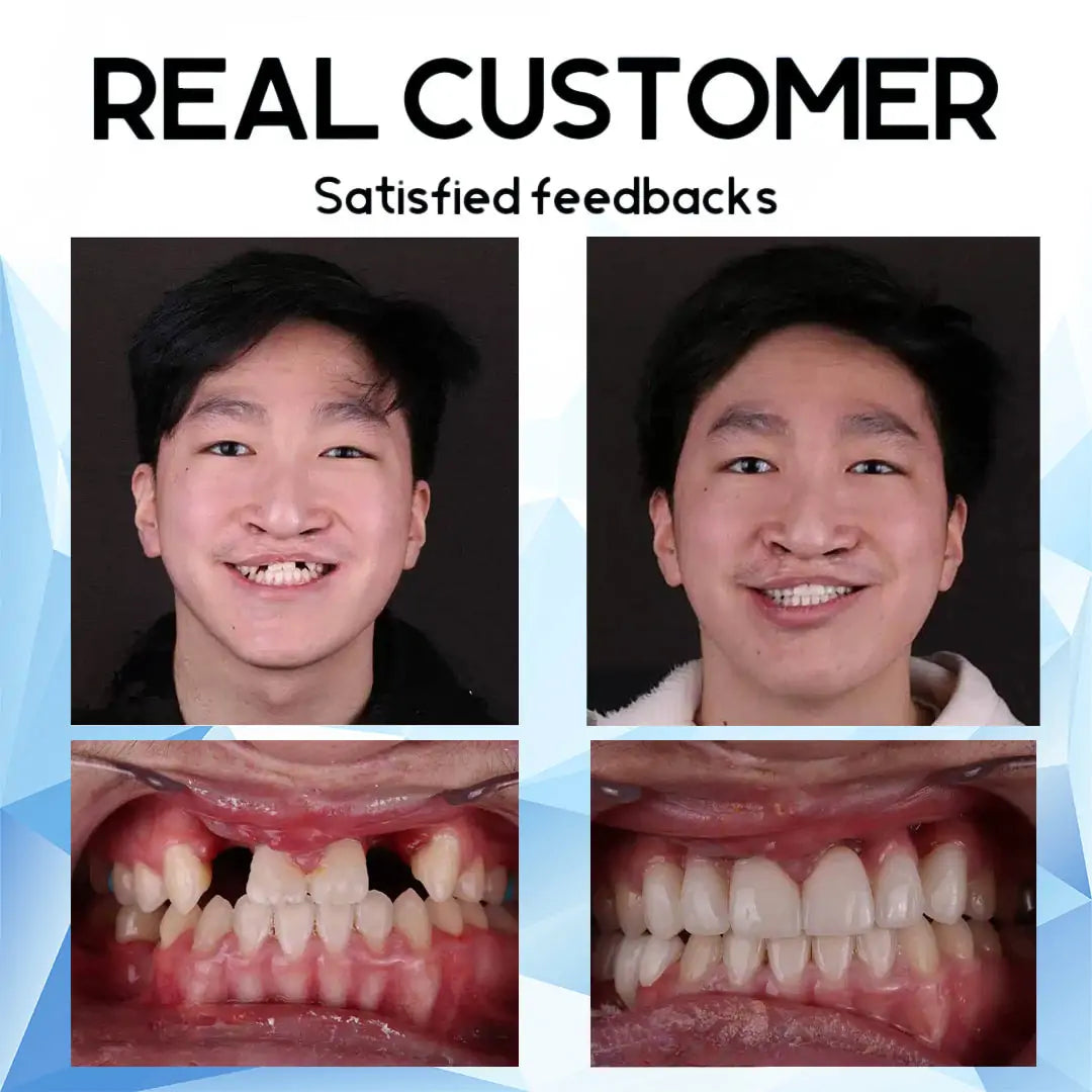 Removable Cosmetic Teeth Veneers for Adults – Instant Smile Enhancer with Silicone Liner, Reusable Snap-On Dental Cover for Natural Look
