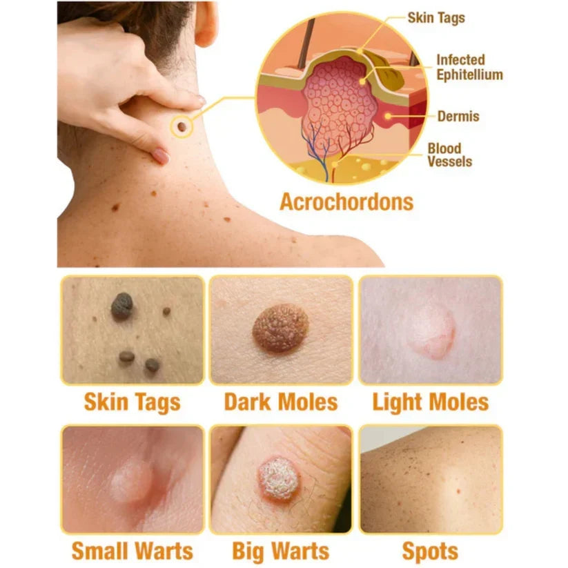Skin Tag & Wart Removal Spray with Natural Bee Venom Extract for Blemish-Free Complexion at Home Treatment