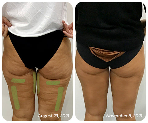 Patch for Reducing Cellulite - Natural Formula