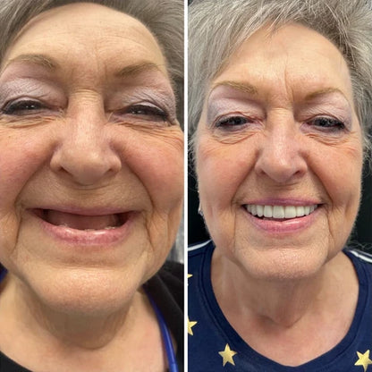 Silicone Denture Kit for Confident All-Day Smiling Without Slipping or Pain