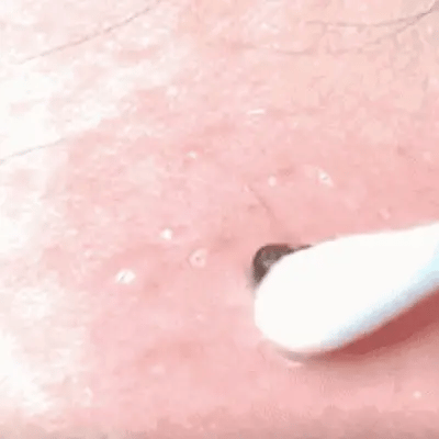 Skin Tag & Mole Remover Cream Fast-Acting Painless Scar-Free