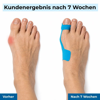 Bunion Tape Toe Alignment & Cushioning 10-Piece Set