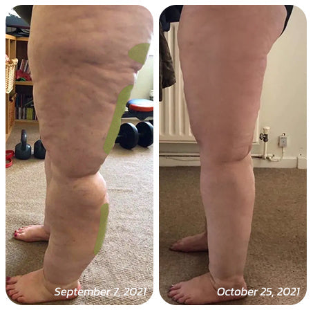 Patch for Reducing Cellulite - Natural Formula