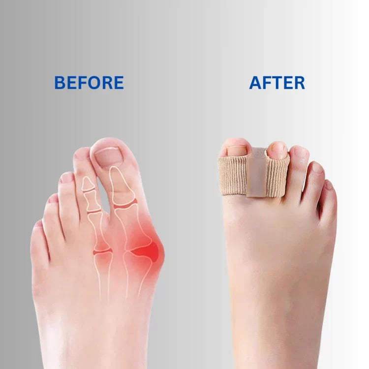 Bunion Corrector Gel Toe Separator Set of 3