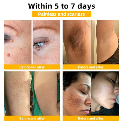 Skin Tag Removal Spray with Natural Bee Venom Extract for At-Home Treatment of Tags, Warts & Moles