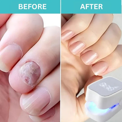 Traitement contre les mycoses des ongles : sérum antifongique quotidien de 7 minutes