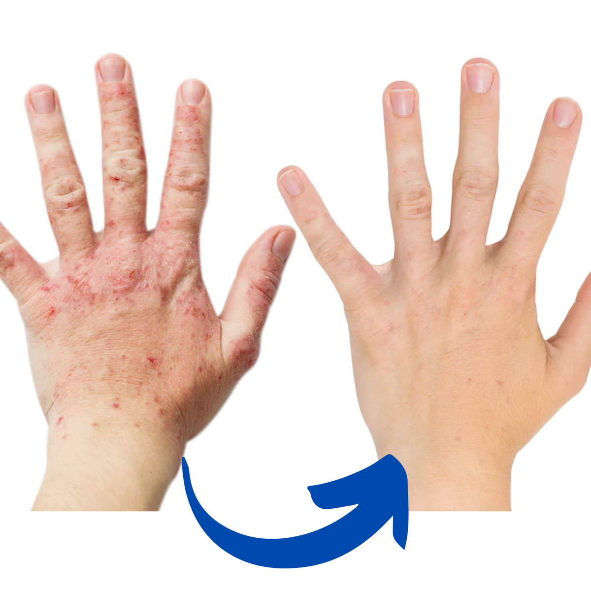 ArthroGlow | Infrared Therapy Gloves for Arthritis Pain Relief with Ergonomic Fit | Natural Solution for Improved Hand Function