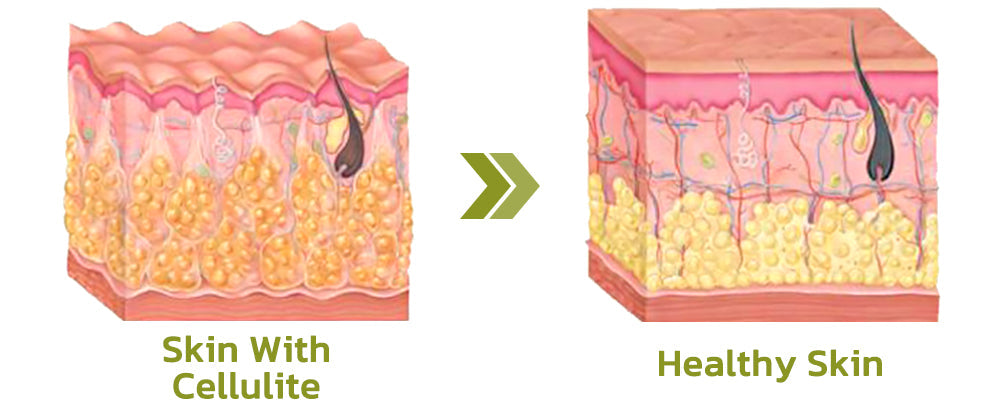 Patch for Reducing Cellulite - Natural Formula