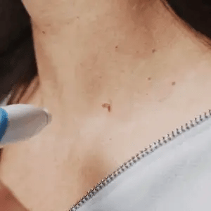 DermaLinx | Wart Remover for Pain-Free Skin Treatment | Effective Solution for Smooth Skin