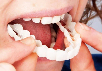 Removable Snap-On Veneers for Temporary Smile Makeover – Heat-Moldable Cosmetic Teeth Covers for Top Teeth