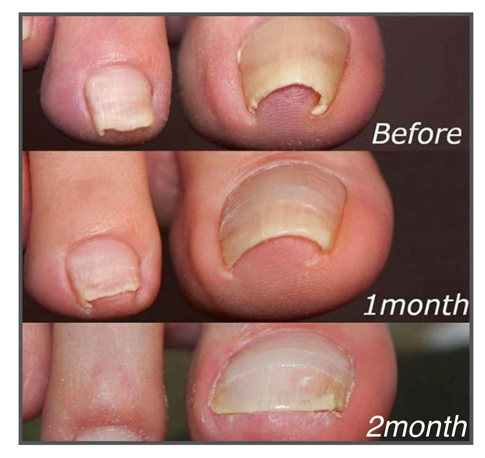 Toenail Alignment Strips for Smooth Appearance | Self-Adhesive Nail Care Patches | Easy Application for Groomed Toenails at Home