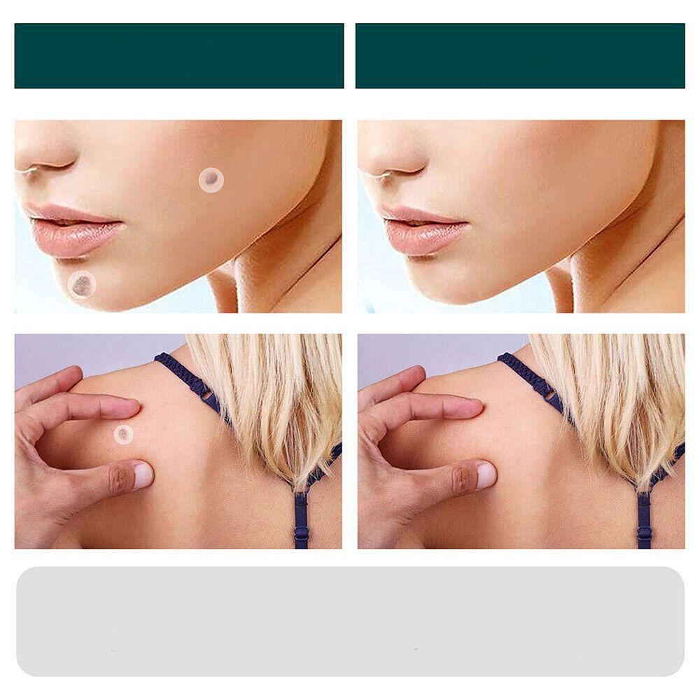 Hydrocolloid Skin Tag & Wart Remover Patches 120-Pack | Gentle Spot Treatment for Home Use | Invisible Adhesive Discs with Tea Tree Oil for