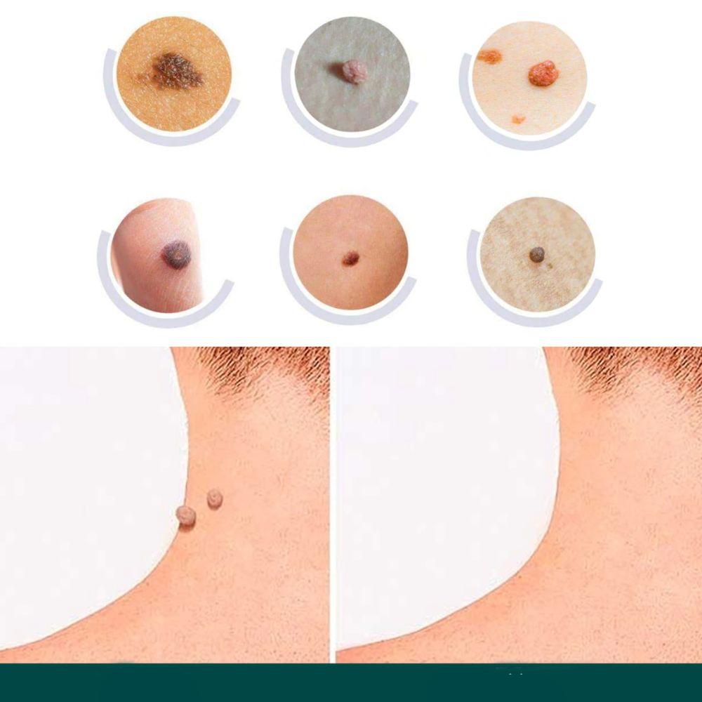 Skin Tag and Wart Removal Patches - Gentle Spot Treatment Stickers for Face Body Neck - Comfortable Adhesive Discs for Blemish Care