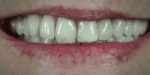 Removable Cosmetic Teeth Covers Set Custom Moldable Dental Veneers for Confidence & Everyday Wear Upper Lower Smile Makeover