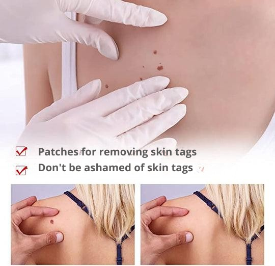 Skin Tag & Wart Removal Pen with Precision Applicator Tip for Spot Treatment at Home | Natural Plant-Based Formula