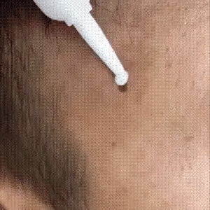 Skin Tag Remover Pen Gentle Painless 20ml