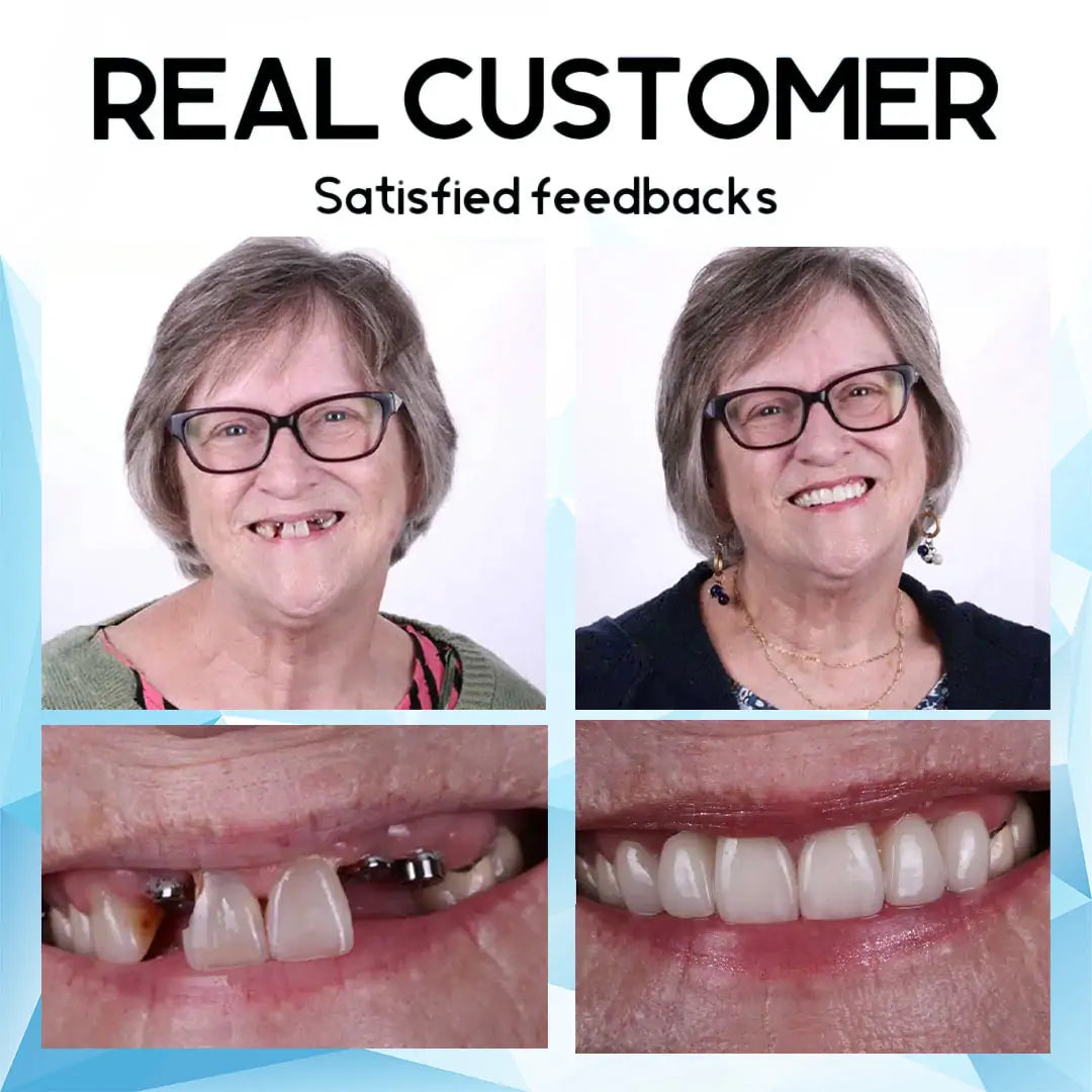 Removable Cosmetic Teeth Veneers for Adults – Instant Smile Enhancer with Silicone Liner, Reusable Snap-On Dental Cover for Natural Look