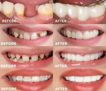 Snap-On Cosmetic Teeth Covers for Upper & Lower Teeth – Instant Smile Veneers for Missing, Broken, or Stained Teeth – Comfortable