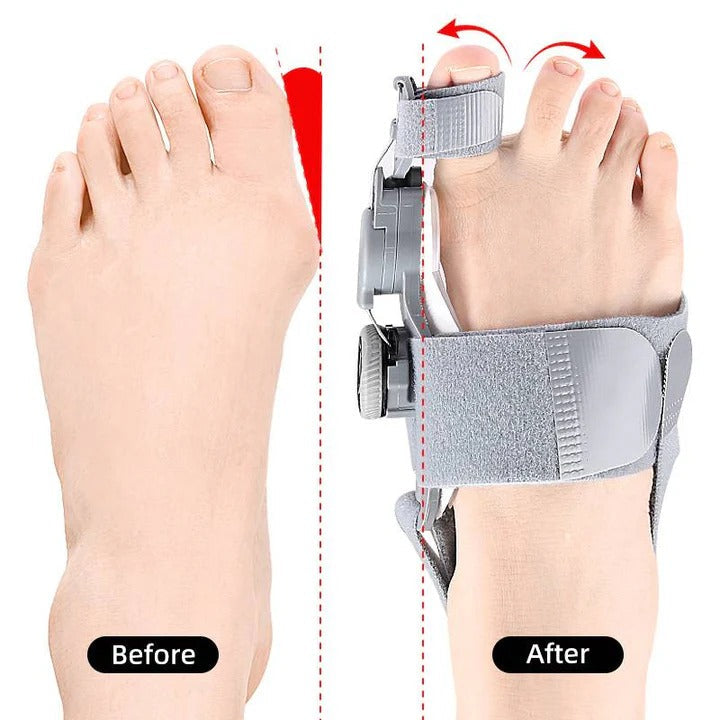 Correcteur d'écartement d'orteils réglable pour l'alignement du pied