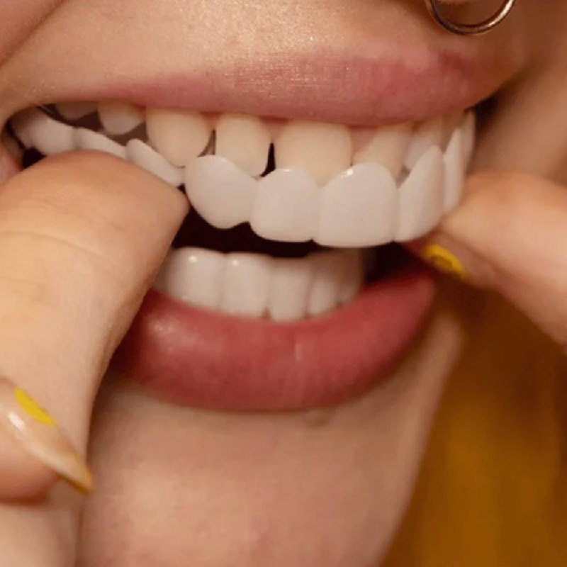 Kit de facettes dentaires facile pour un sourire parfait