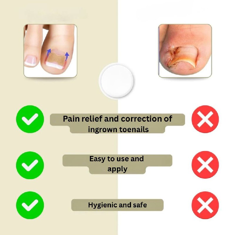 Solution rapide pour les ongles cassés et incarnés