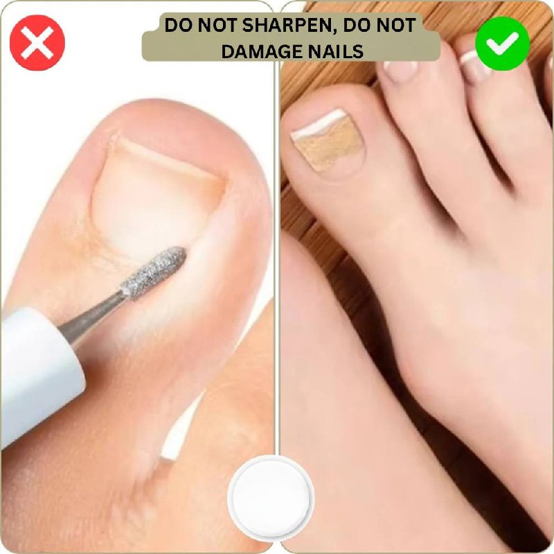 Solution rapide pour les ongles cassés et incarnés