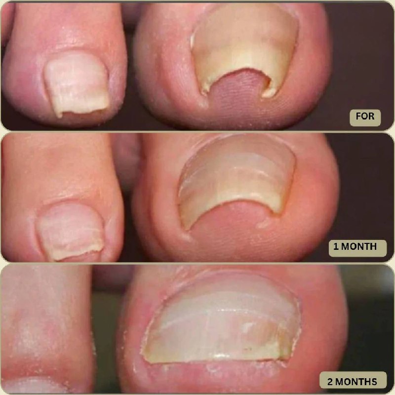 Solution rapide pour les ongles cassés et incarnés