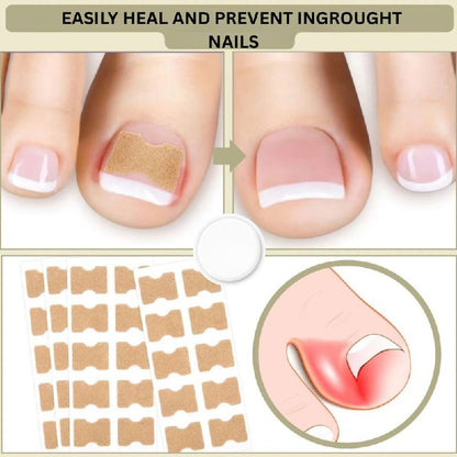 Solution rapide pour les ongles cassés et incarnés