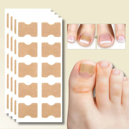 Fast Nail Fix for Broken and Ingrown Nails - Ortekor