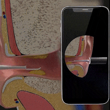 Wireless Ear Cleaning Camera with HD Scope and Silicone Tip for iPhone & Android Safe Wax Removal Tool